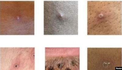 lesiones que provoca la viruela del mono